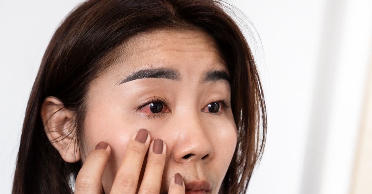 pink eye vs. allergies